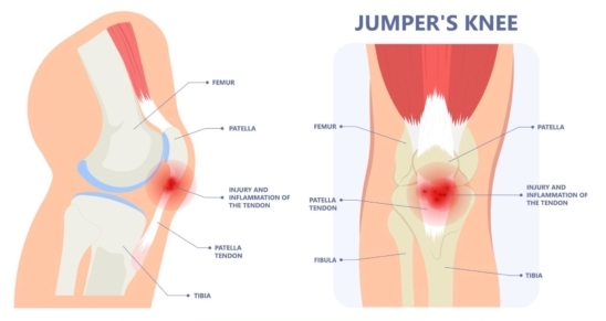 Zobrazení místa bolesti skokanského kolene u běžců.
